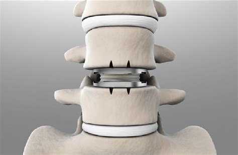 Spinal Disc Replacement Supporting Pain Free Mobility Through Next