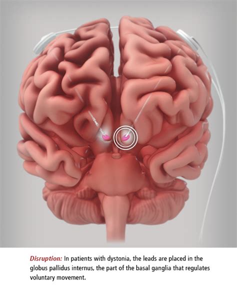 Easing Dystonia Symptoms With Deep Brain Stimulation