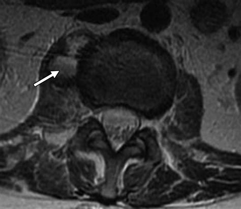 Recurrent Pain After Percutaneous Vertebroplasty AJR