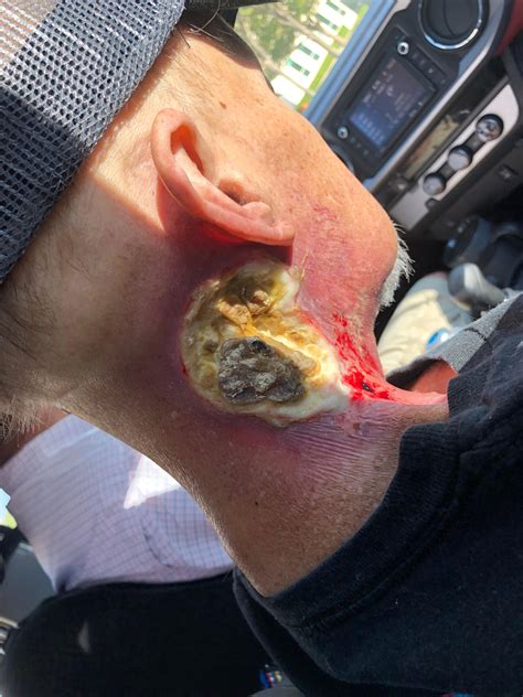 Head and neck cancer is a group of cancers that starts in or near your throat, voice box, nose, sinuses, or mouth. Hpv cancer reddit - Examenele obligatorii de ginecologie