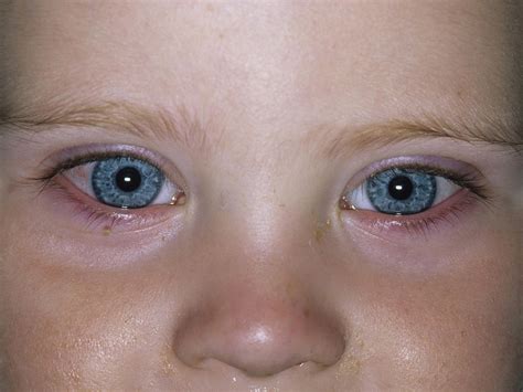 Cellulitis Under Eye