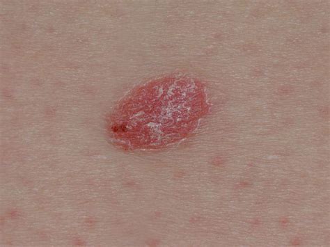 Is Dry Skin A Sign Of Skin Cancer Cancerwalls