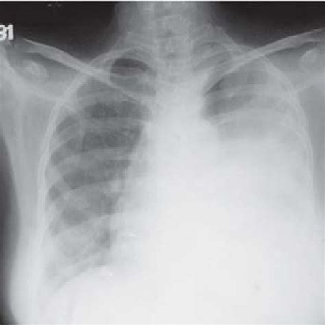Chest Radiograph Postero Anterior View Showing A Homogeneous Opacity