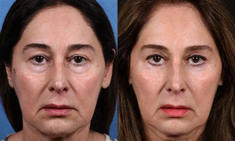 Eyelid Lift And Fat Transfer In San Diego By Dr John Hilinski