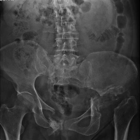 pelvic x ray showing the detachment of the right pelvis with a download scientific diagram