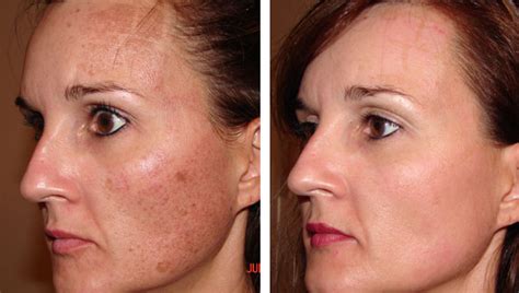 Age Spot Removal Gallery Skin Rejuvenation Clinic