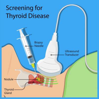 Thyroid Fine Needle Aspiration Biopsy Procedure Sample Tissue Fotomural