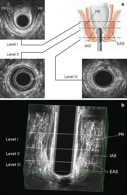 Three Dimensional Endoanal Ultrasonography Of The Anorectal Region Radiology Key