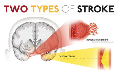 Stroke Dr Todd Leslie