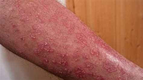 Día Mundial de la Dermatitis Atópica enfermedad daña la piel y el autoestima El Mañana de
