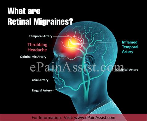 Retinal Migraines Causes Symptoms Treatment Diagnosis