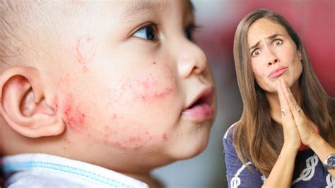 Baby Eczema What Does It Look Like And How To Treat It Naturally