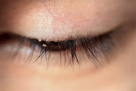 Blepharitis From Eyelash Extensions Tips And Relief Corneacare