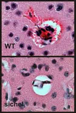 Rote blutkörperchen sind normalerweise wie scheiben geformt, die es ihnen ermöglichen, durch blut zu wandern schiffe. Warum Sichelzellenanämie vor Malaria schützt - Mechanismus ...