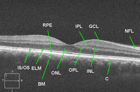 Normal Retinal Anatomy The Retina Reference