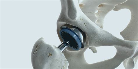 The Pros And Cons Of Titanium Hip Replacements Brandon Orthopedics