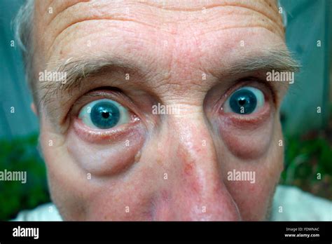 Bulging Eyes Hi Res Stock Photography And Images Alamy