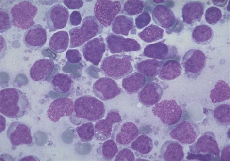 Mantle Cell Lymphoma The Lancet Oncology