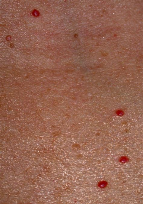 Small Flat Red Spots On Skin Images And Photos Finder