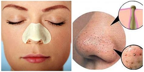 Blackheads View From An Expert Dermatologist Grace Skincare Clinic