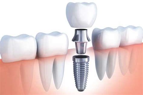 Implantes Dentales De Carga Inmediata Clínica Dental Dr Pablo Murillo