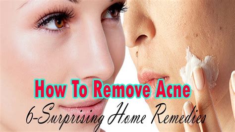 How To Remove Acne Pimples Overnight 100 Works 6 Surprising Home