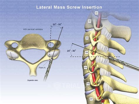 Lateral Mass Screw Inserion Trial Exhibits Inc