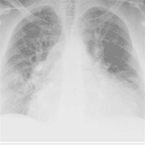 Chest X Ray Showing Widespread Interstitial Infiltrates And