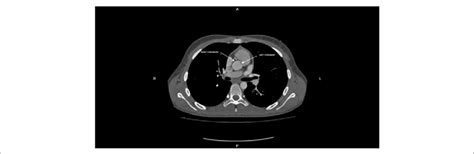 Coronary angiogram at initial diagnosis: CT angiography shows anomalous origin of the left coronary ...