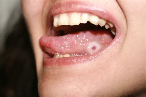Tongue Sores During Pregnancy - Causes, Symptoms & Treatments - Being ...