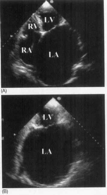 Echocardiography End Systolic Frames From Apical Window A