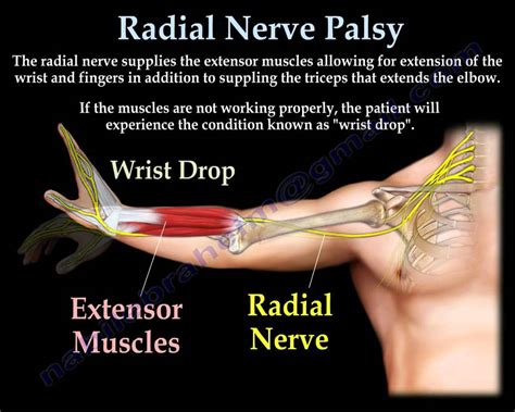 Wrist Pain Nerve Damage Mapageprek