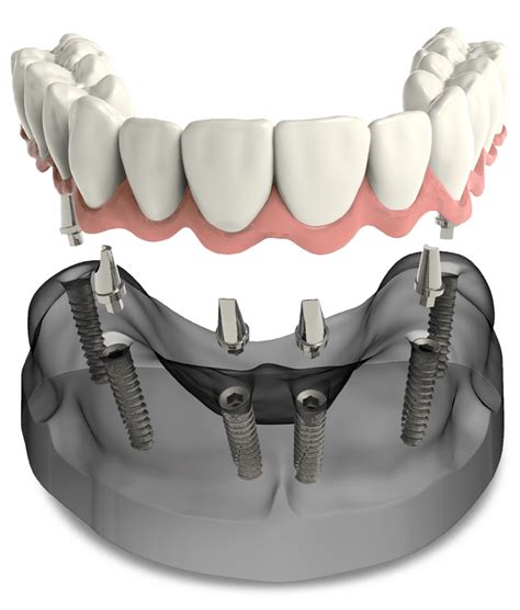 Full Arch Dental Implants - OMSA Oral Surgery Group