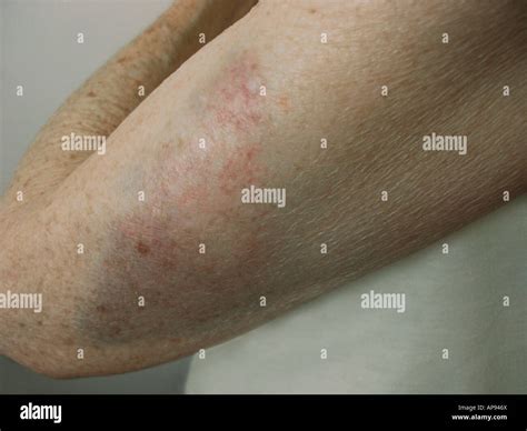 Elderly Woman With A Badly Bruised Arm Stock Photo Alamy