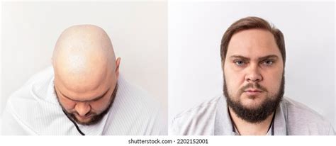 2285 Balding Process Images Stock Photos And Vectors Shutterstock