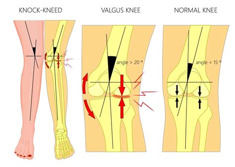 What Are Knock Knees Gv Correct