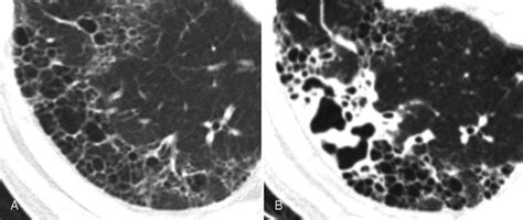 A 61 Year Old Man With Usual Interstitial Pneumonia Uip Proven By The