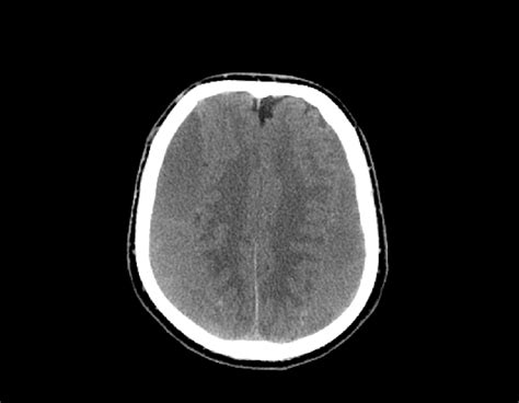 Ct Scans Showing A Bilateral Chronic Subdural Hematoma Download