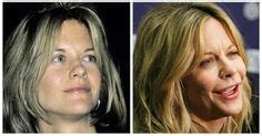 Meg Ryan Plastic Surgery Before And After Facelift And Botox Ideas