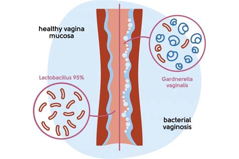 Vaginal Dryness During Sex My Menopause Centre