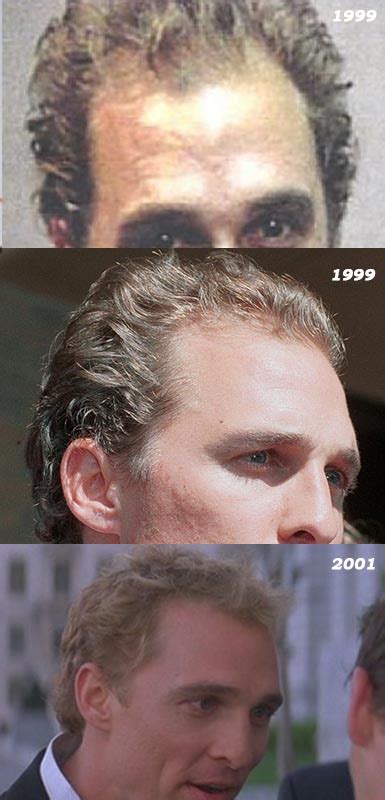 Thinning Corners Hairline Black Male - Thinning Hairline Black Male Reddit