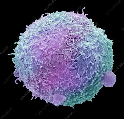 Positive molecular findings by reverse transcriptase. Breast cancer cell, SEM - Stock Image - C038/8750 ...