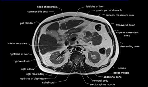 Abdominal Anatomy Ct Scan Ct Abdomen Pelvis Lower Axial Labeling