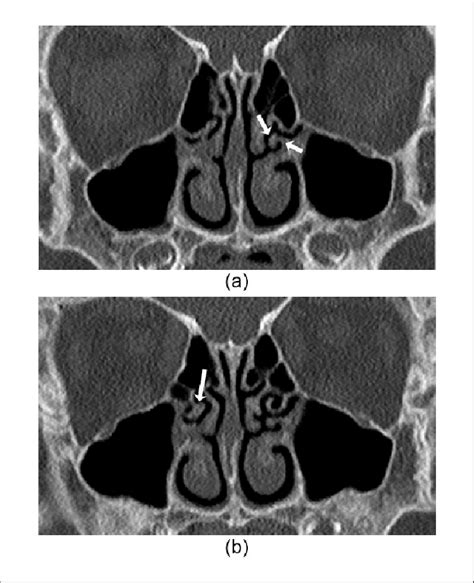 Coronal Computed Tomography Images Of The Nasal Cavity And Paranasal