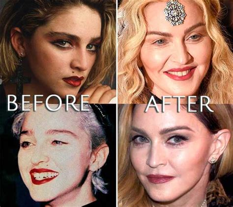 Madonna Plastic Surgery Facelift Eyelift Lip Injections