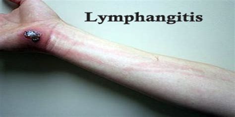 Lymphangitis Assignment Point