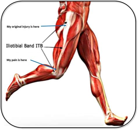 Iliotibial Band Itb Friction Syndrome Warm Witty Words Health