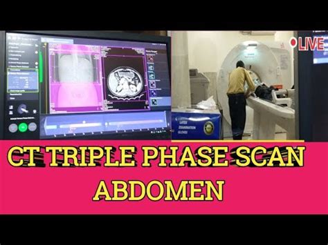 CT SCAN Triple Phase Abdomen Contrast Scanning Process Live CT Scan