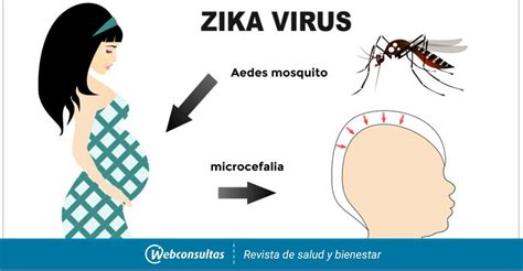 Descubren El Mecanismo Por El Que El Zika Causa Microcefalia Al Feto