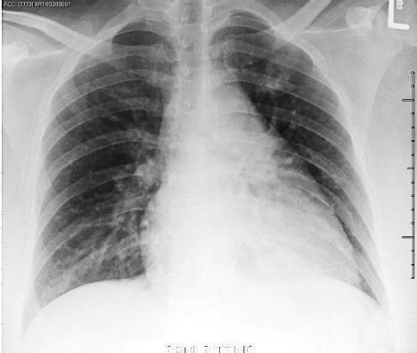 It describes the unusual association of fetal and placental hydrops with maternal preeclampsia. Mirror Syndrome: A Novel Cause of Shortness of Breath in ...